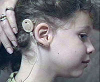 Image from Sound and Fury: Girl with Cochlear Implant.