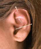 Ear Accupuncture