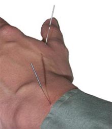 Accupuncture in a hand