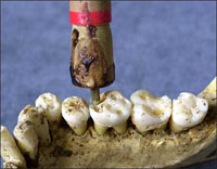 "A close-up of the reconstructed drill boring into a tooth." 