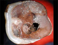 "A Neolithic molar that shows signs of having been worked on by a prehistoric dentist." 