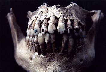 Dental decoration by filing and incrustation methods; Ixtonton, Guatemala; Classic Period.