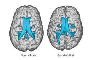Temple Grandin Brain Scan